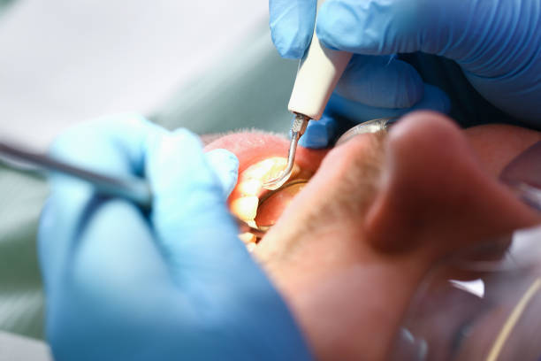 Best Emergency Tooth Extraction in White River Junction, VT